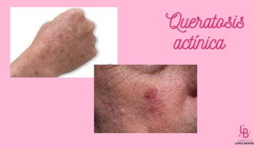 Queratosis actínica: cada vez más frecuente