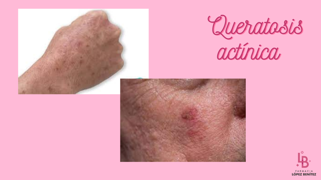 Queratosis actínica