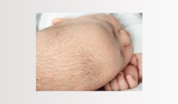Costra láctea , dermatitis seborreica en bebés