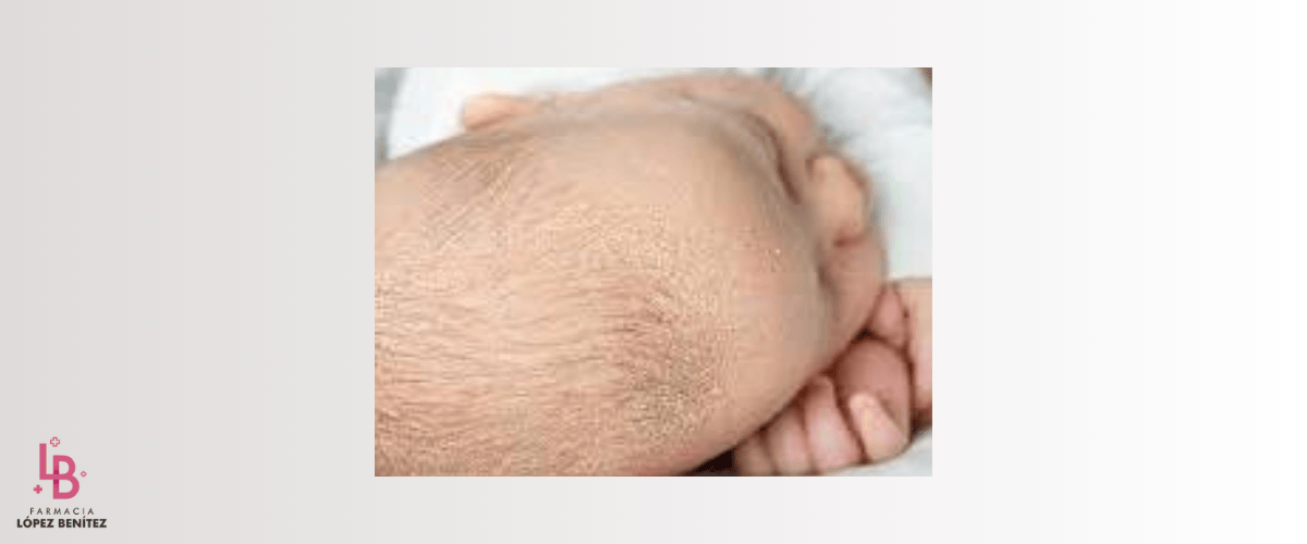 Costra láctea bebé