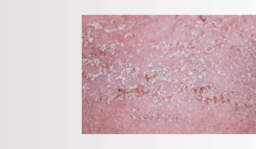 Controla la Dermatitis Seborreica y Recupera la Salud de tu Cuero Cabelludo