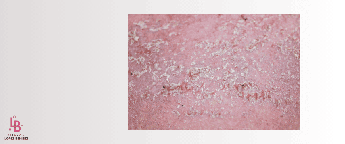 dermatitis seborreica