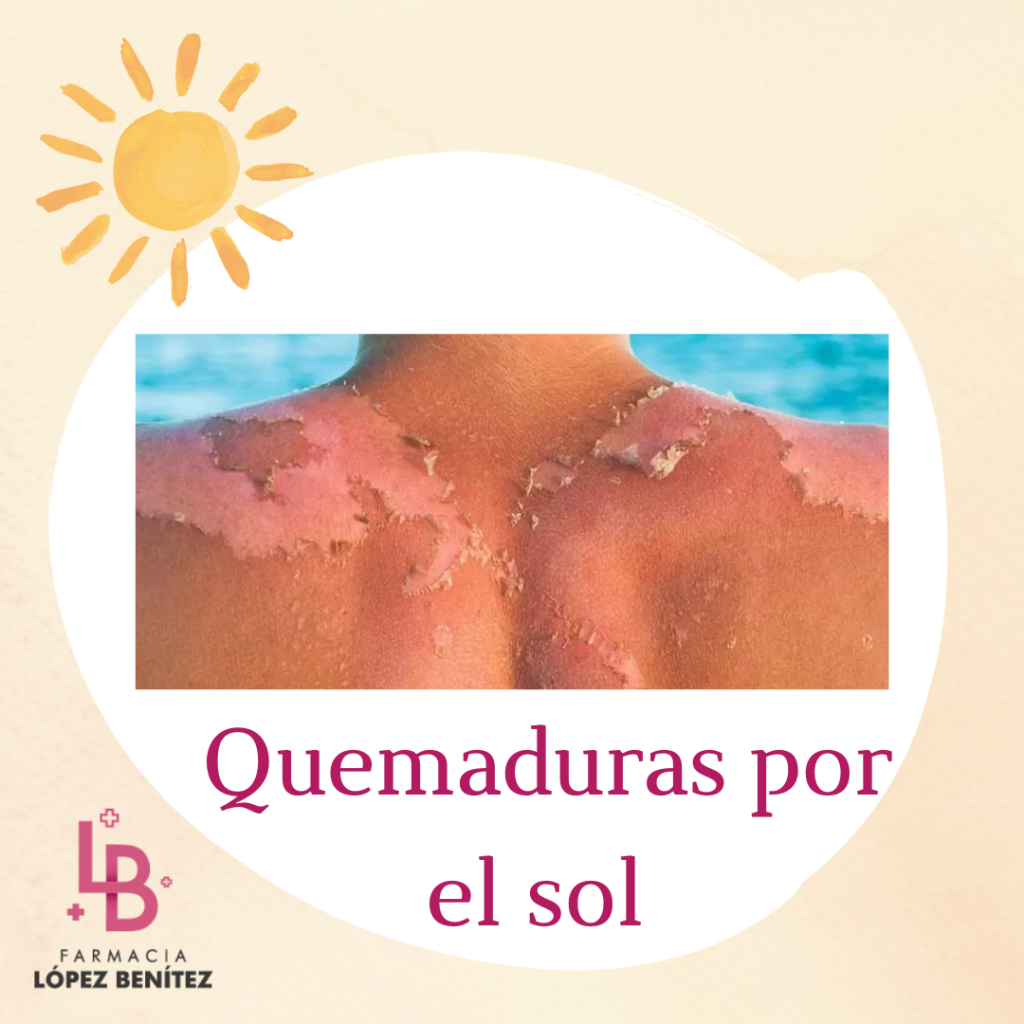 quemaduras por el sol