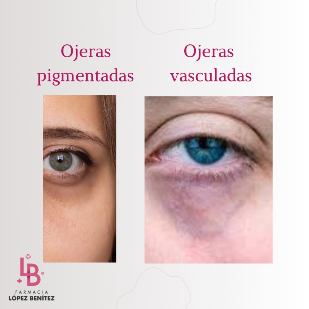 tipos de ojeras