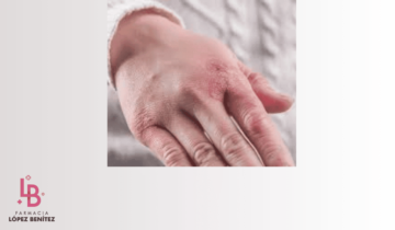 Consejos para tratar los sabañones